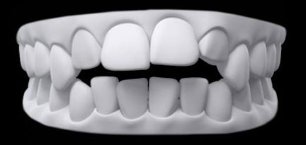 Mușcătură deschisă