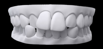 Înghesuire dentară